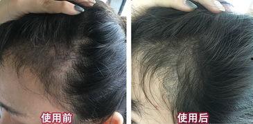 秃额角明星,揭秘娱乐圈中的独特魅力